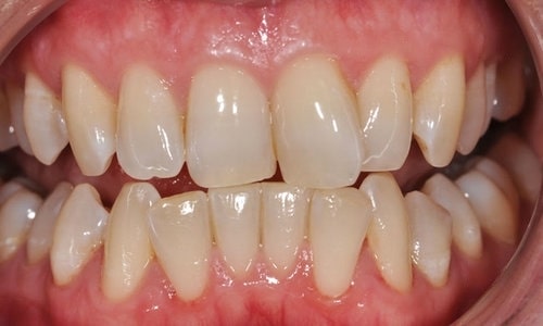 alinhadores-1-lidery-odontologia-antes