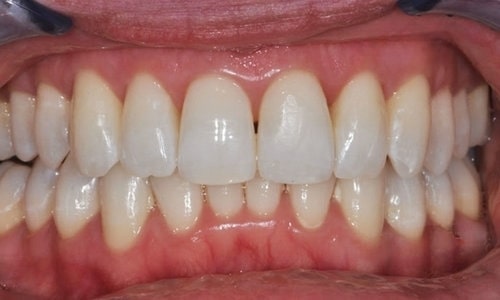 alinhadores-1-lidery-odontologia-depois