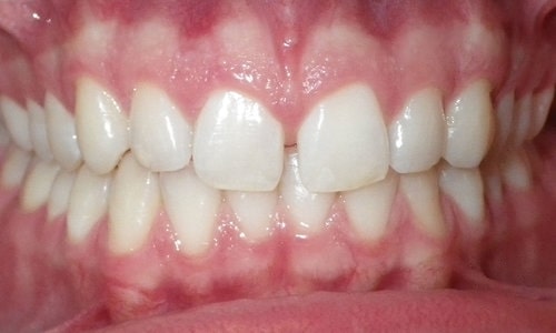 alinhadores-2-lidery-odontologia-antes