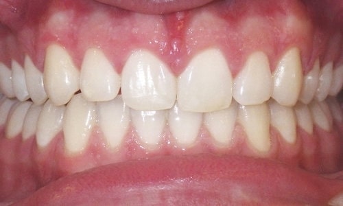 alinhadores-2-lidery-odontologia-depois