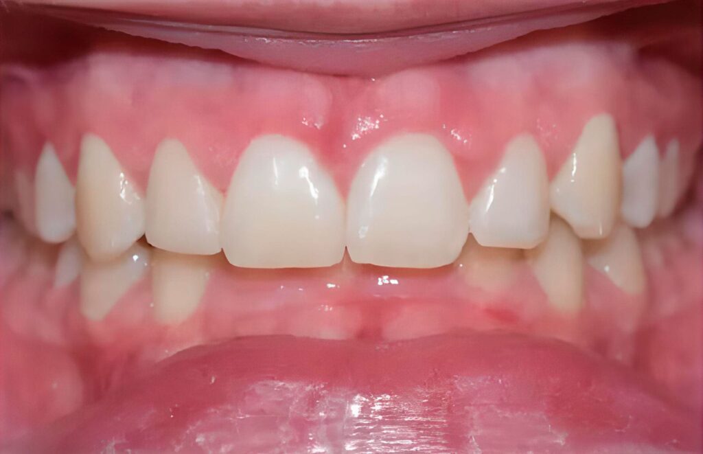 Cirurgia oral 2 cirurgia-oral-depois-2