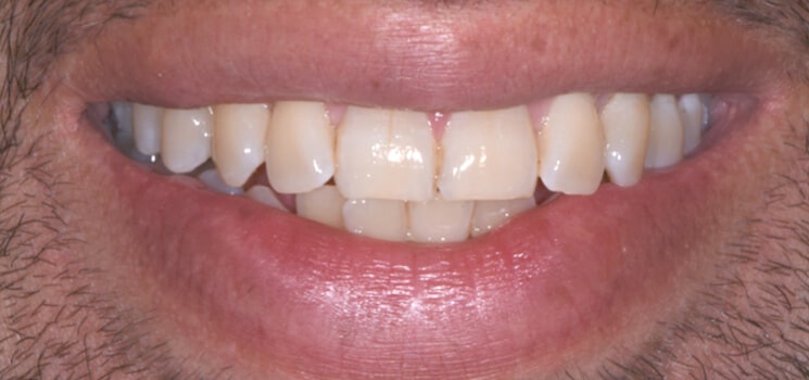 clareamento-dental-odontologia-antes