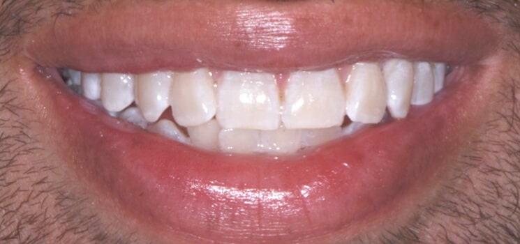 clareamento-dental-Curitiba-depois