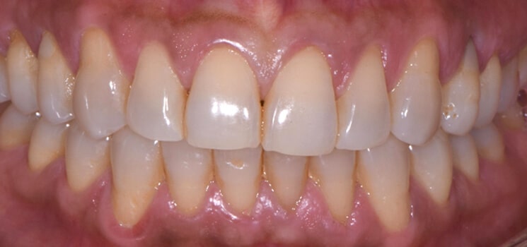 clareamento-dental-Curitiba-2-antes