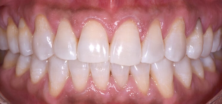clareamento-dental-Curitiba-2-depois