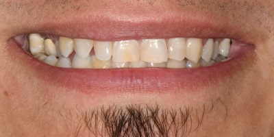 facetas-dentarias-curitiba-antes-1