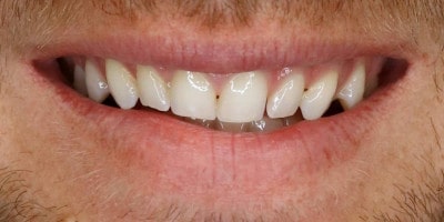 facetas-dentarias-curitiba-2-antes