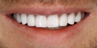 facetas-dentarias-curitiba-depois