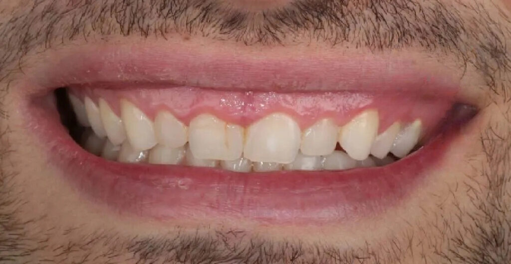 Cirurgia oral 3 gengivecto-antes