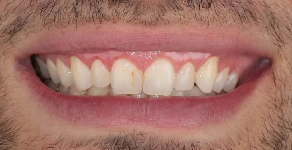 Cirurgia oral 4 gengivecto-pos