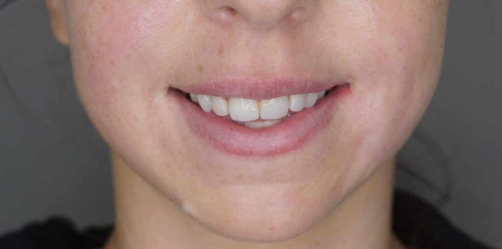 harmonizacao-facial-1-lidery-odontologia-depois