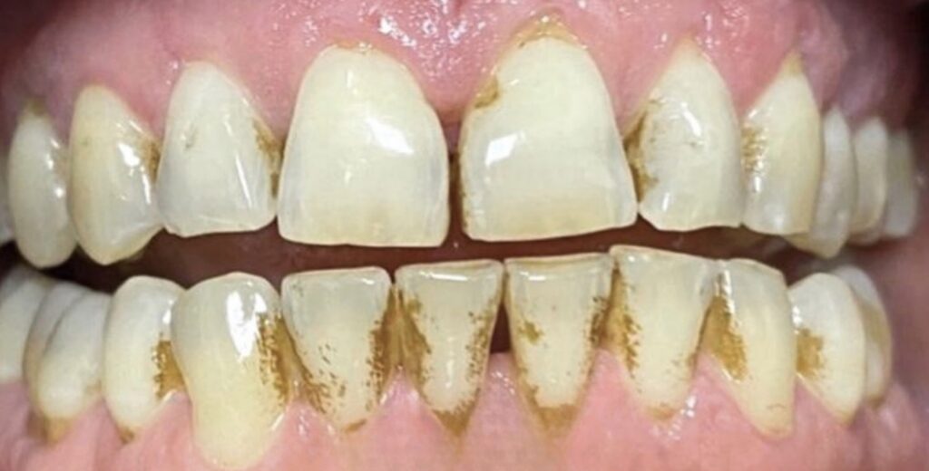 limpeza-1-lidery-odontologia-antes