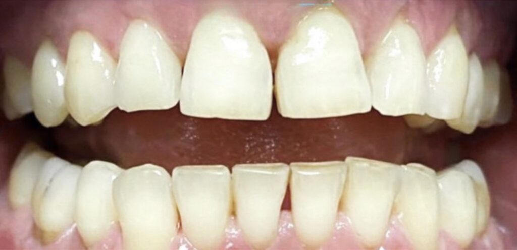 limpeza-1-lidery-odontologia-depois