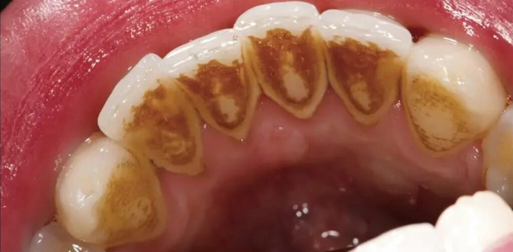 limpeza-2-lidery-odontologia-antes