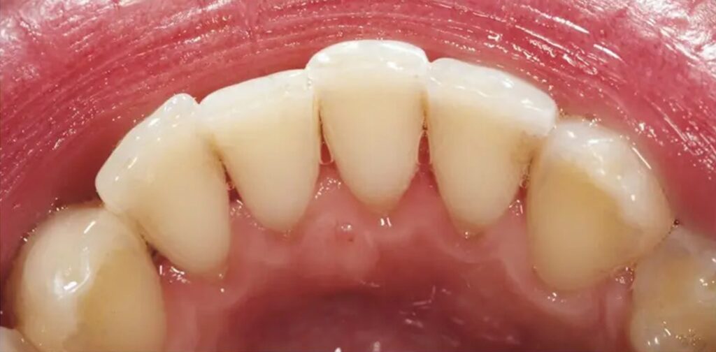 limpeza-2-lidery-odontologia-depois