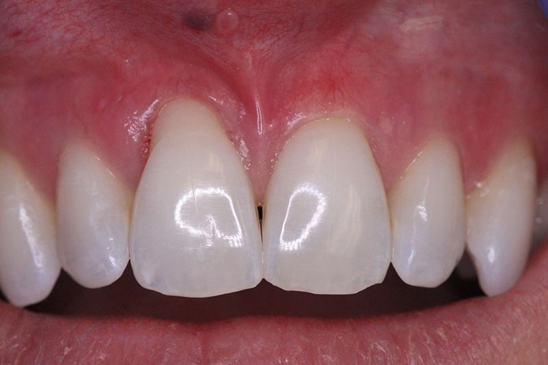 periodontia-enxerto-antes