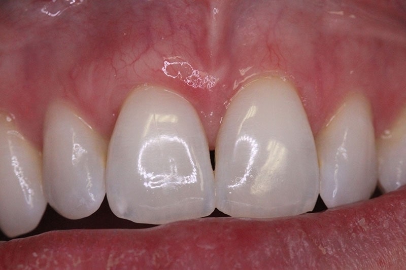 periodontia-enxerto-depois