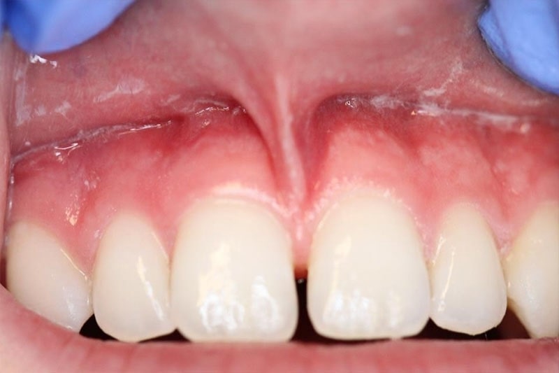 periodontia-frenectomia-antes