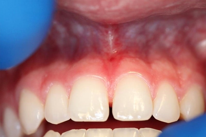 periodontia-frenectomia-depois