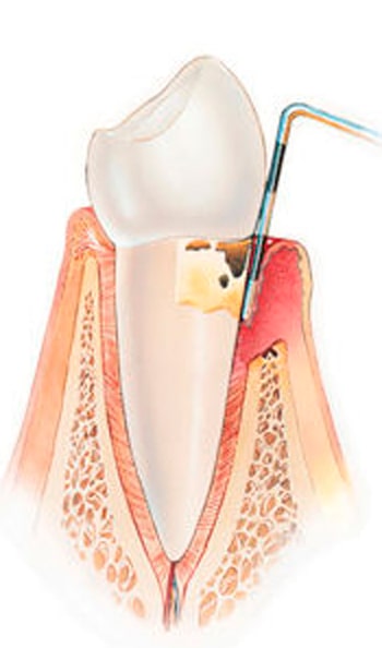 periodontite-cronica