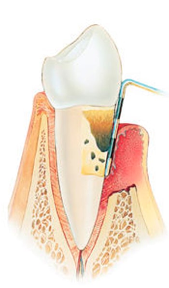 periodontite-necrosante