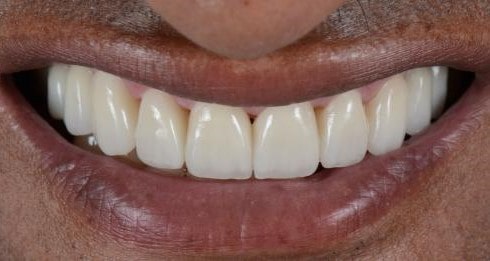 protese-total-1-depois