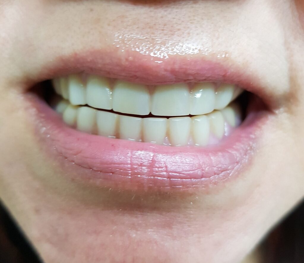 protese-total-2-antes