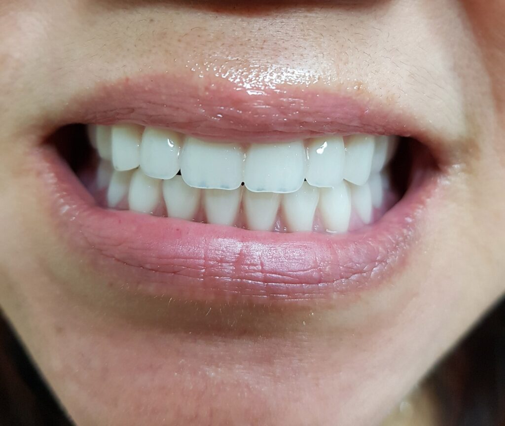 protese-total-2-depois