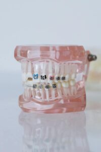 Modelo dental com aparelho ortodôntico metálico em clínica
