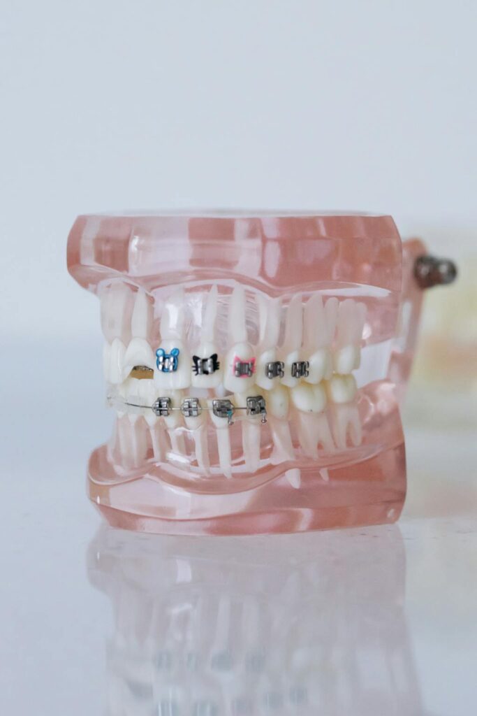 Modelo dental com aparelho ortodôntico metálico em clínica