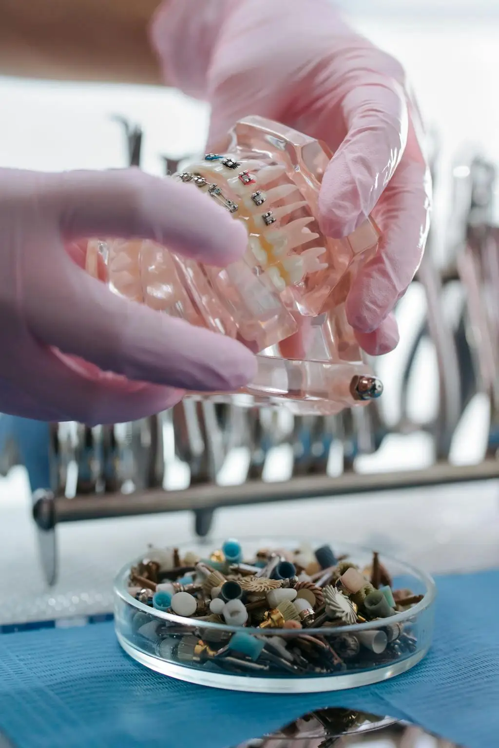 Modelo de prótese dental para tratamento de dente escurecido
