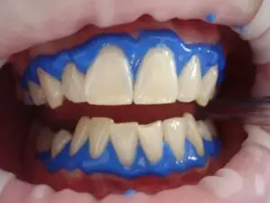 Clareamento dental a laser para tratamento de dentes amarelados
