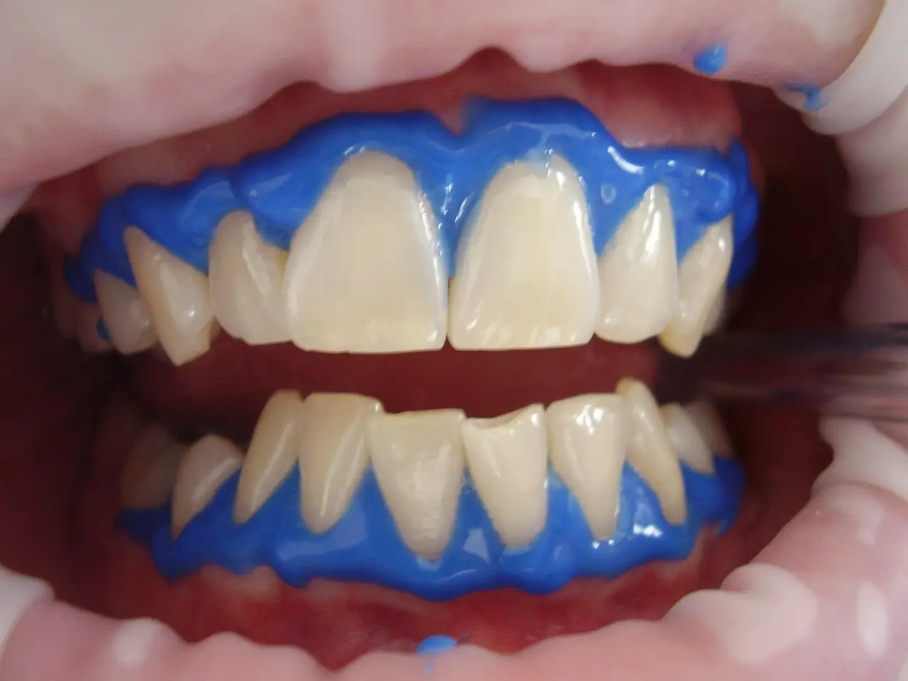Clareamento dental a laser para tratamento de dentes amarelados