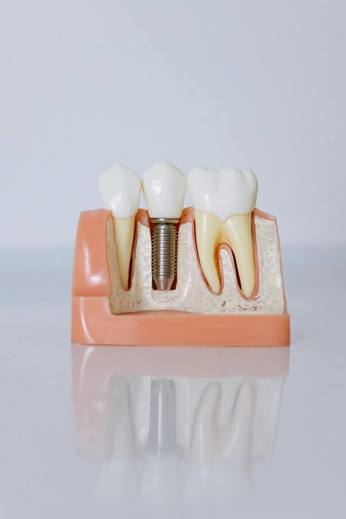 Modelo de implante dentário mostrando anatomia e possíveis complicações