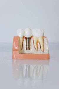 Modelo de implante dentário mostrando anatomia e possíveis complicações