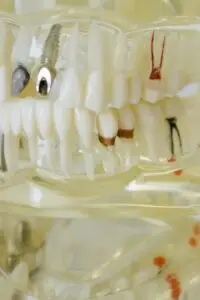 Modelo detalhado de implante dental mostrando estrutura interna com componentes