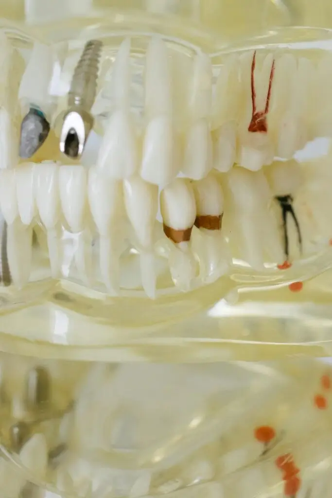 Modelo detalhado de implante dental mostrando estrutura interna com componentes