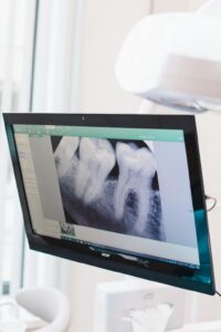 Radiografia panorâmica dental mostrando dentes siso em monitor de consultório odontológico