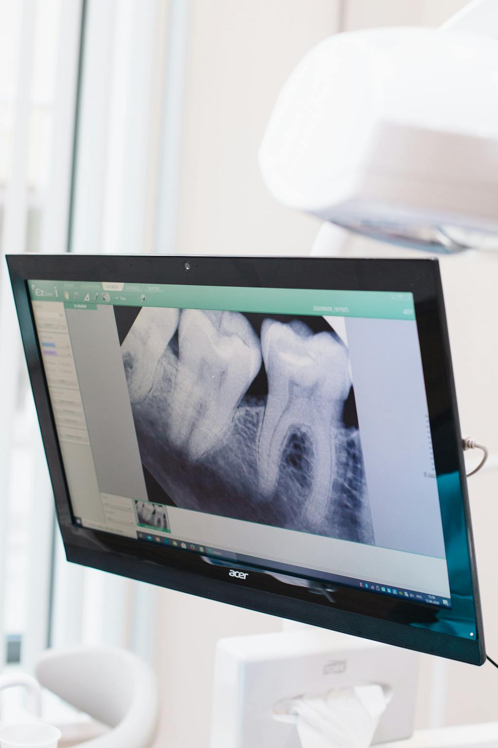 Radiografia panorâmica dental mostrando dentes siso em monitor de consultório odontológico