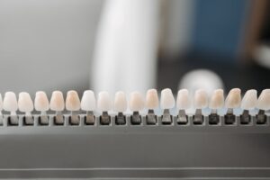 Resultado estético de restauração dental em resina composta