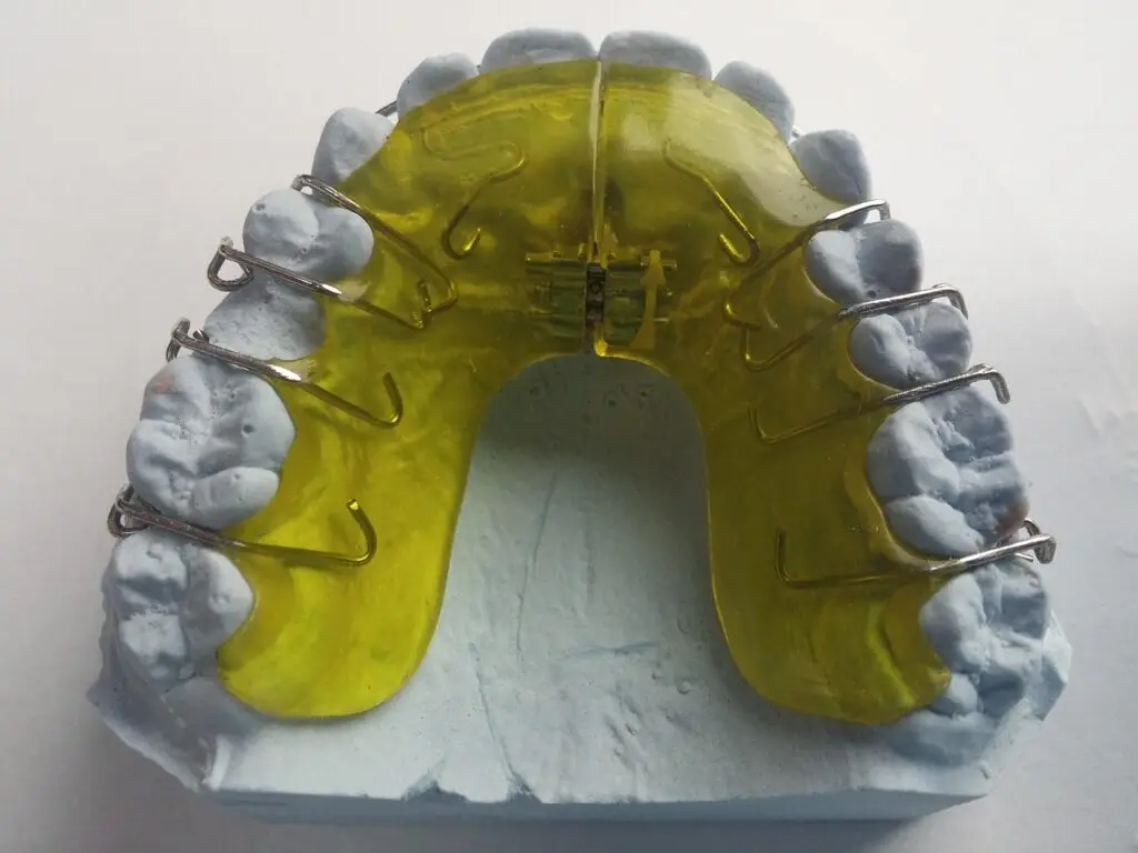 Modelo dental com aparelho ortodôntico para correção de sobremordida